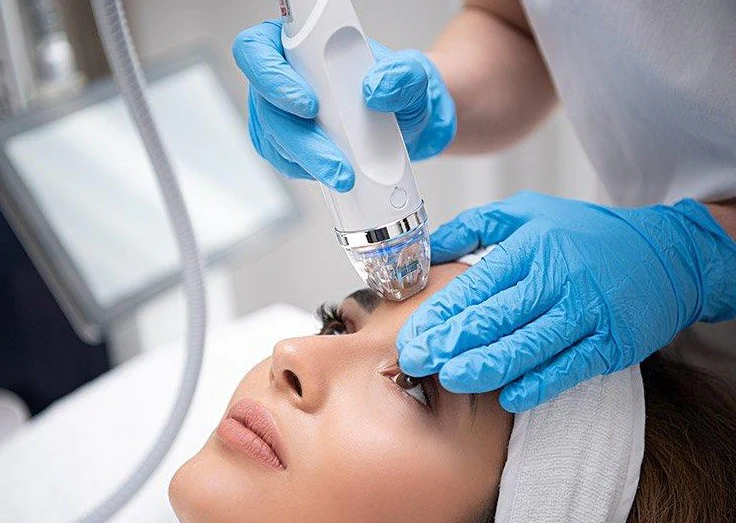 microneedling RF