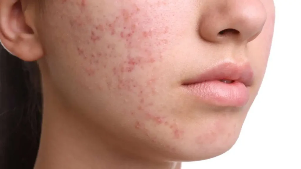 Fungal Acne Causes Treatment and Prevention