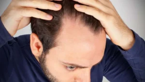 does high testosterone cause hair loss