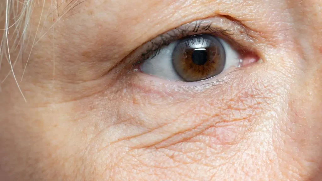 Under-Eye Wrinkles Treatment